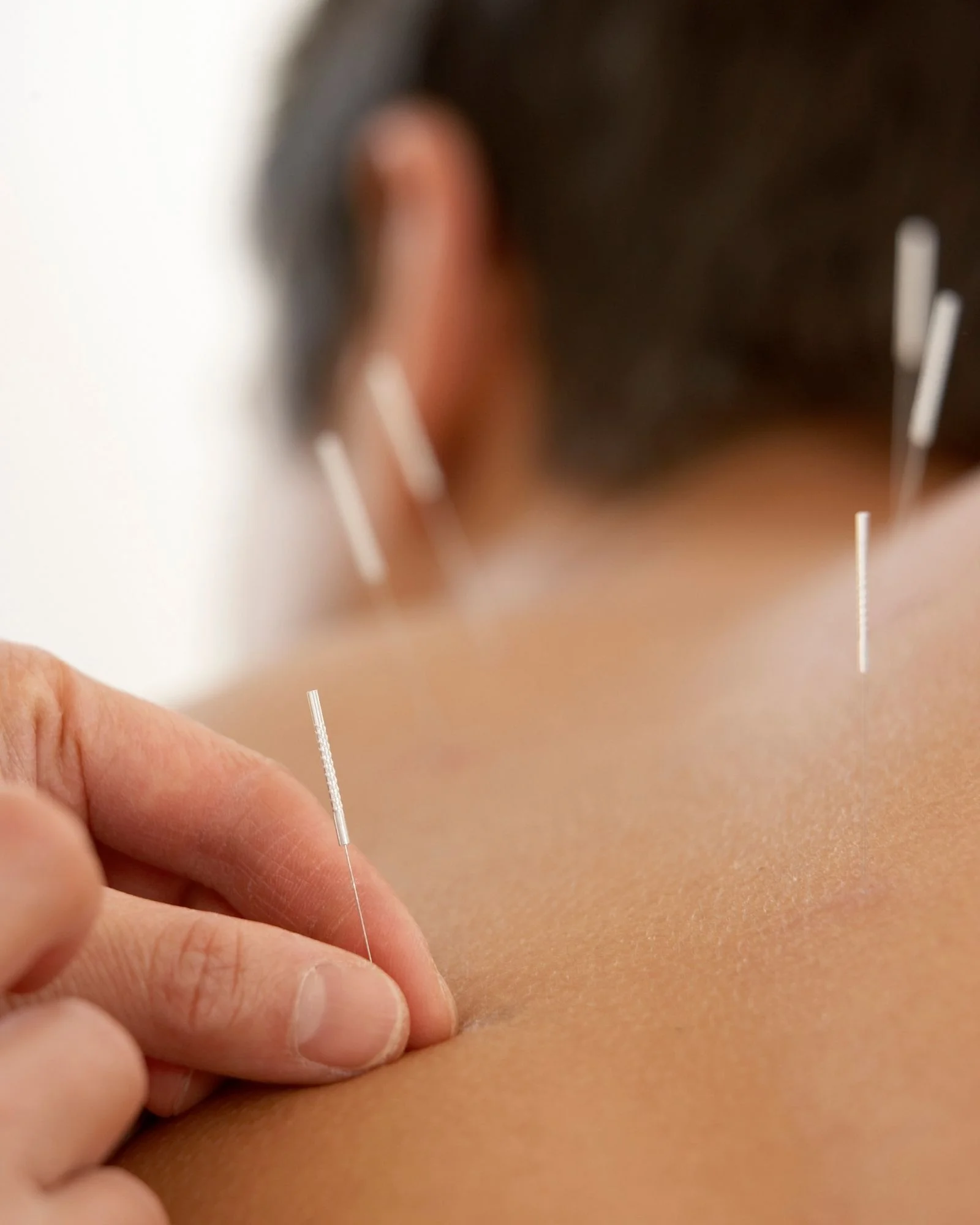 Acupuncture treatment at Sinew Center Minneapolis